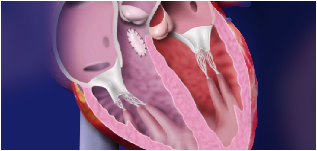 Ventricular Septal Defectin Hindi